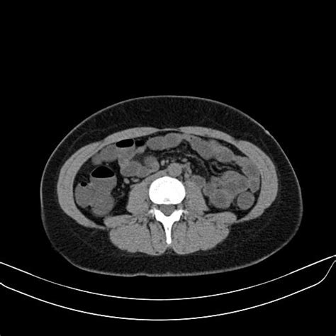 Radiopaedia Case Ulcerative Colitis Id Study Nc Commons