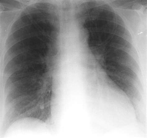 Nonthrombotic Pulmonary Emboli Ajr