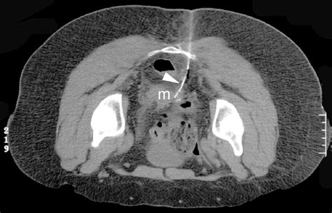 Various Approaches For Ct Guided Percutaneous Biopsy Of Deep Pelvic