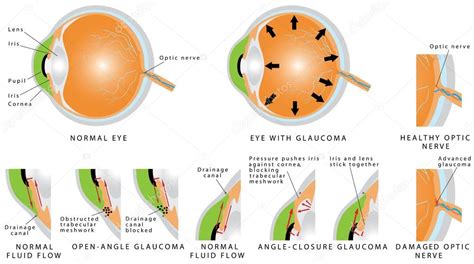 Glaucoma — Stock Vector © Anutuno 78968170