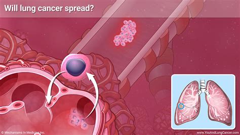 Slide Show Understanding Small Cell Lung Cancer