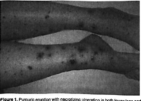 Rare Case Of Metformin Induced Leukocytoclastic Vasculitis Semantic