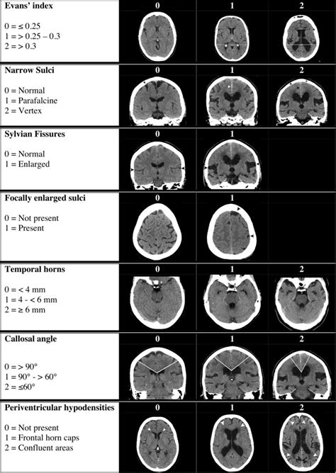 Idiopathic Normal Pressure Hydrocephalus Historical Context And A Contemporary Guide