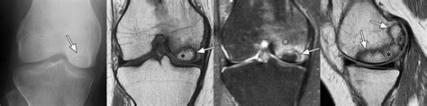 Osteochondral Lesions Of The Knee Differentiating The Most Common