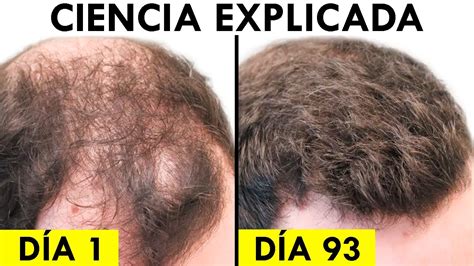 Minoxidil Oral Mg Vs T Pico Cu L Es Mejor Youtube