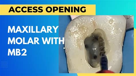 Maxillary Molar Access Opening With Mb2 Youtube