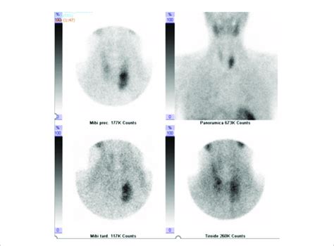 Dual Phase Tc 99m Sestamibi Scintigraphy Early 5 And 30 Min And