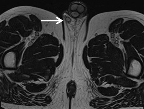 Testicular Tumors What Radiologists Need To Know—differential