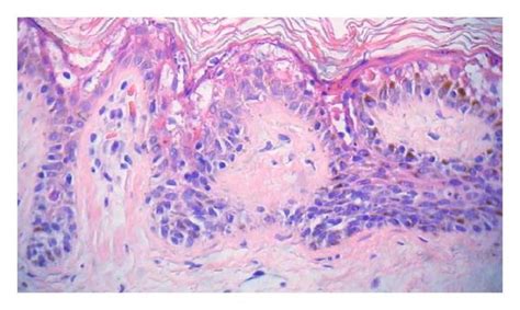 Incidental epidermolytic hyperkeratosis occurring in association with a... | Download Scientific ...