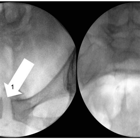 Fluoroscopic Stress Pelvic Views Radiograph In A 30 Year Old Female Download Scientific Diagram