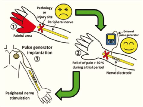 A representative diagram of peripheral nerve stimulation for the ...