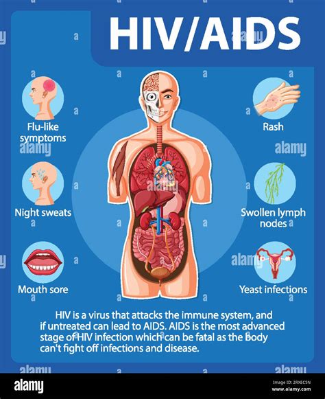 Illustration Depicting How Hivaids Virus Attacks And Affects The Human Body Stock Vector Image