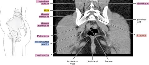 CT of the female pelvis | Radiology Key