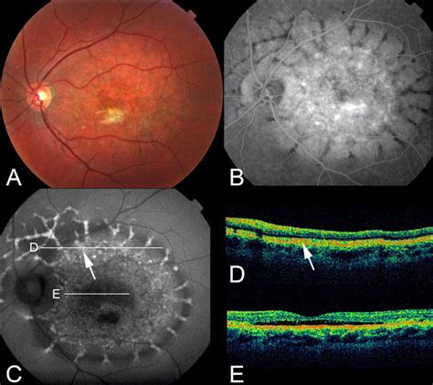 Vitelliform Macular Dystrophy Ophthalmology