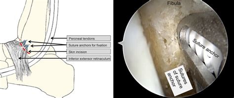 Arthroscopic Modified Brostrom Operation Allows Faster Recovery In