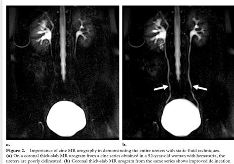 Figure 2 From Mr Urography Techniques And Clinical Applications Semantic Scholar