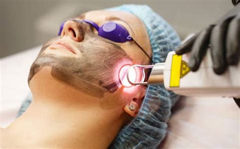 Carbon Laser Peel