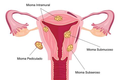 Os Tipos De Miomas Uterinos Cl Nica Ayroza Ribeiro