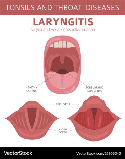 Tonsils and throat diseases laryngitis symptoms Vector Image