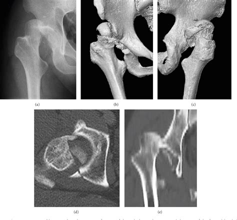 Figure From Femoral Varus Osteotomy For Hip Instability After