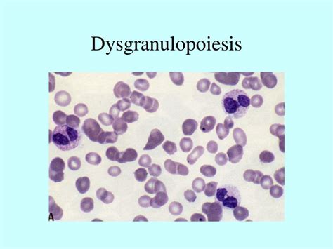 Ppt Myelodysplastic Syndrome And Acute Myeloid Leukaemia Powerpoint