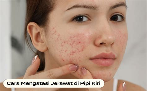 Cara Mengatasi Jerawat Yang Muncul Di Pipi Kiri Dan Artinya