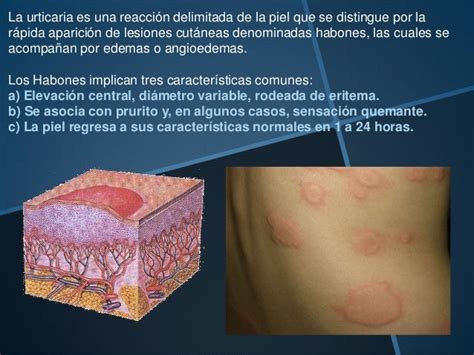 Urticaria Tratamiento Y Fisiopatologia