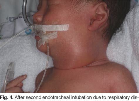 Figure 4 From A Case Of The Ex Utero Intrapartum Treatment Procedure For Fetal Giant Fourth