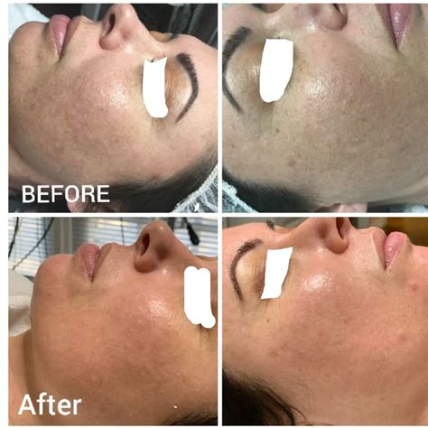 Orlando Dermapen Micro Needling