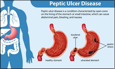 Peptic Ulcers Causes Risk Factors Symptoms Treatment