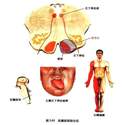 中枢神经系统疾病定位诊断图解脑干精讲 脑医汇 神外资讯 神介资讯