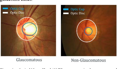 Figure 1 from Optic Disc and Optic Cup Segmentation on Retinal Image ...