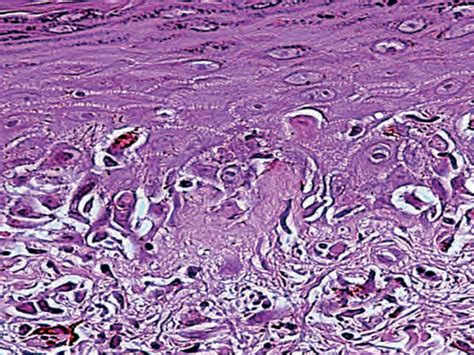 Scielo Brasil Cutaneous Graft Versus Host Disease After