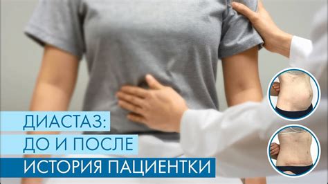 Диастаз: история преображения пациентки - YouTube