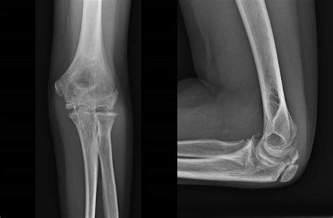 Anteroposterior And Lateral Plain Radiographs Of Left Elbow In Case