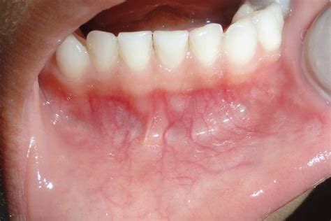 Oral Mucocele A Case Report Pdf Download Available