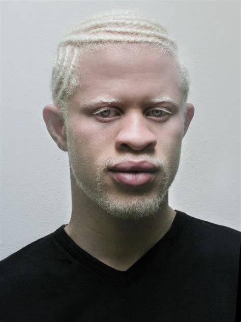 Exploring The Unique Identity Of The Albino Black Guy A Deep Dive Into