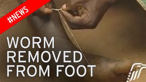 Horrific X Ray Shows Parasite Worm Stuck Inside Man S Foot For Years Mirror Online