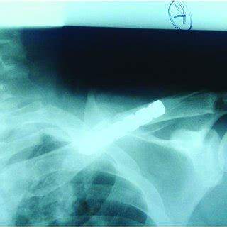 Clavicular X-ray Day 1 post operation. | Download Scientific Diagram