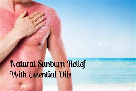 Natural Sunburn Relief With Essential Oils - melsaywhat