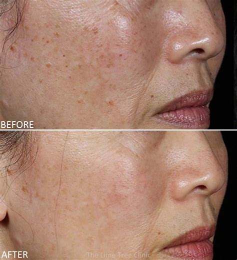 Pigmentation Removal Perth Laser Skin Pigmentation Treatment