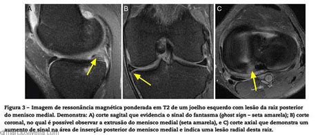 Meniscos Tipos De Lesões Causas E Tratamentos Dr Márcio Silveira