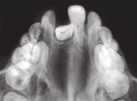 Preoperative Occlusal Radiograph Download Scientific Diagram