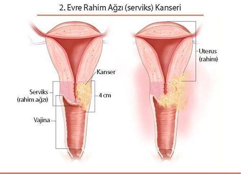 Rahim Kanseri Belirtileri Resimli