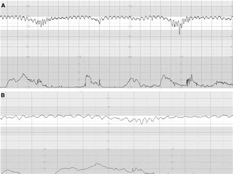 Pathophysiological Interpretation Of Fetal Heart Rate Tracings In Clinical Practice American