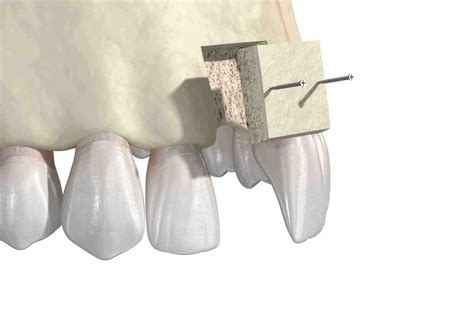 How Long After Teeth Extraction To Allow Dental Implant With Bone Graft