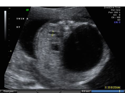 Hydronephrosis Obstetrics And Gynecology