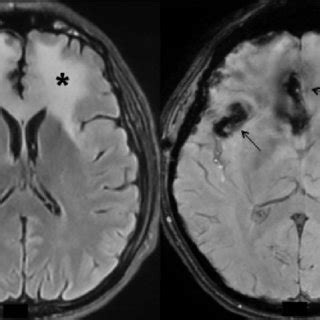 Axial Diffusion Weighted Image Dwi Mri Shows Signal Prolongation And