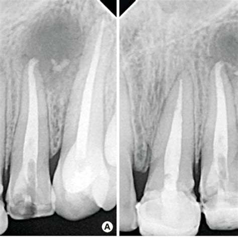 Intraoral Periapical Radiographs A Immediate Postoperative