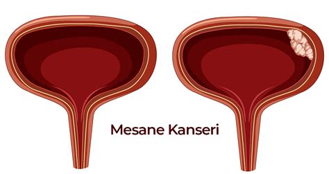 Mesane Drar Kesesi Kanseri Nedir Uzm Dr Numan Do U G Ner